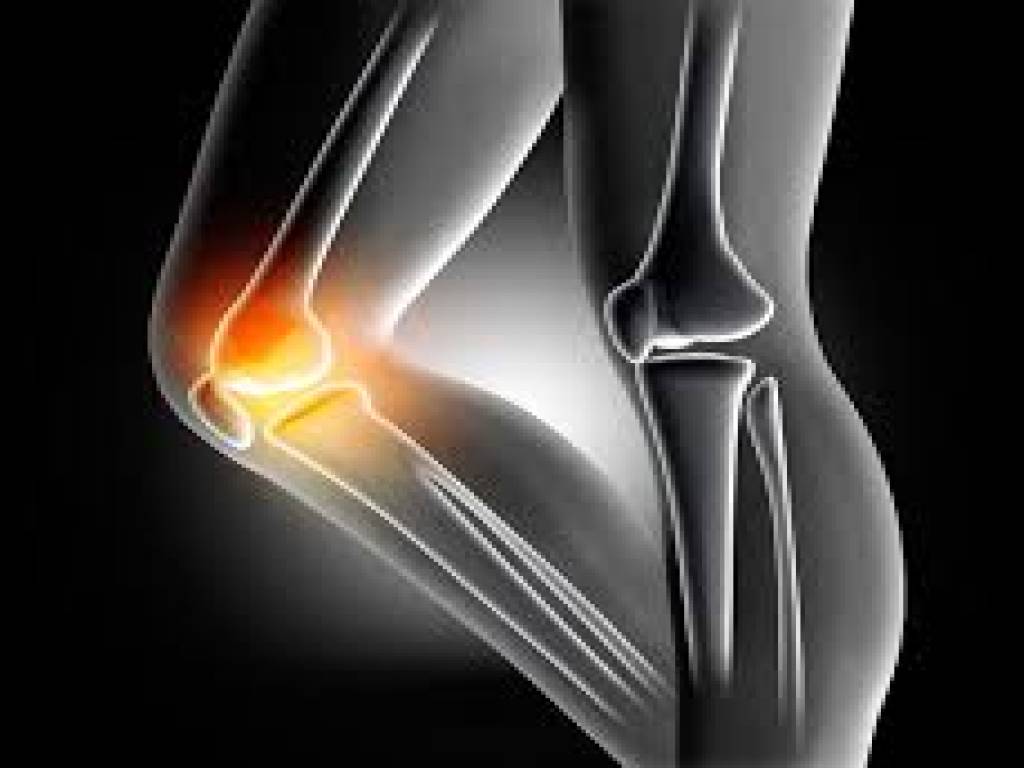 Imagen 2ª Parte; Artrosis de rodilla Inflamación de rodilla