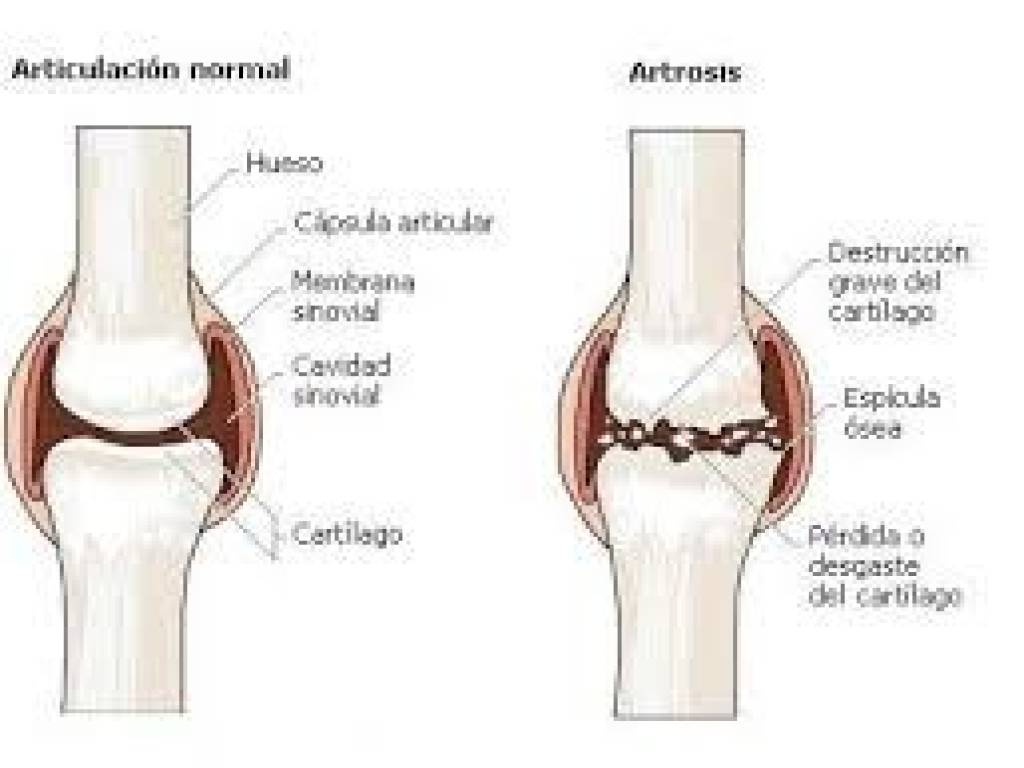 Foto 3º parte, artrosis de rodilla Diferencias entre articulación sana y deteriorada